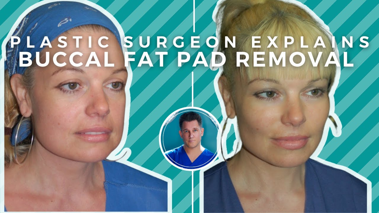 BUCCAL FAT PAD REMOVAL: Surgery, Recovery, Before and After 