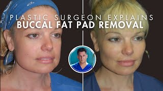 BUCCAL FAT PAD REMOVAL: Surgery, Recovery, Before and After