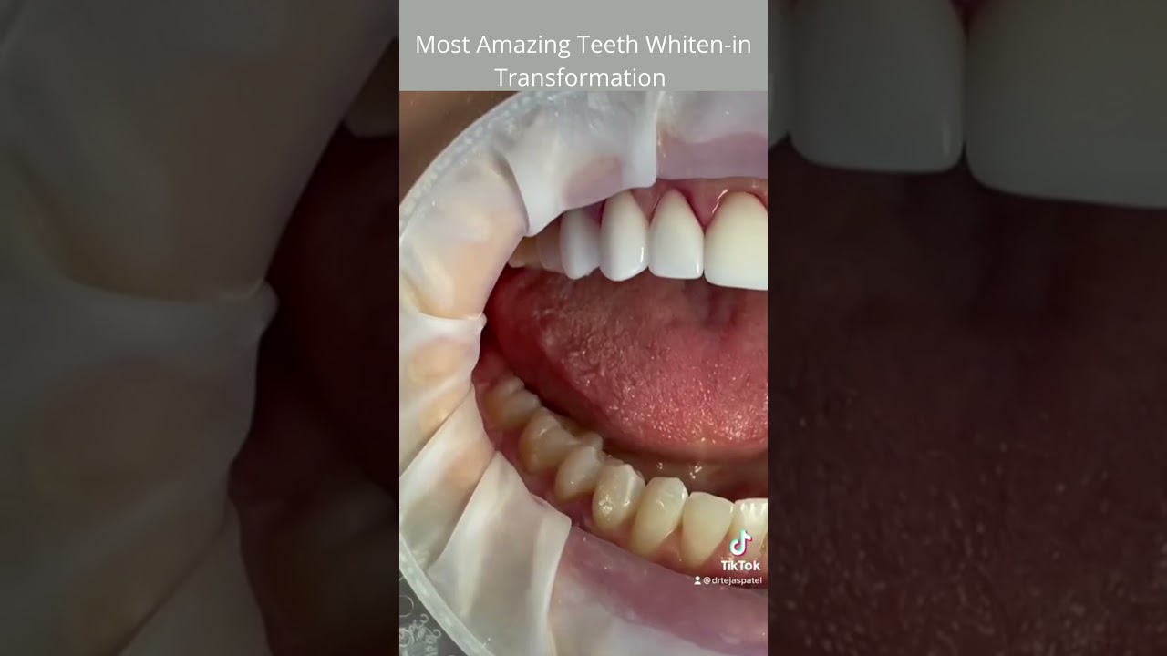 Most Amazing Teeth Whiten-in Transformation/Motivation by Drtejaspatel