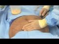 Liposuction of a woman's abdomen