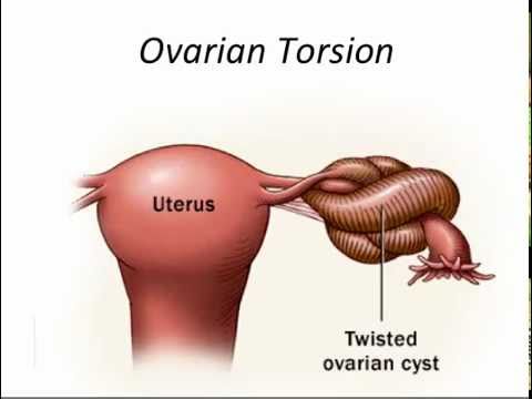 Video: Ovarial Torsion: Symtom, Orsaker, Behandling Och Mer