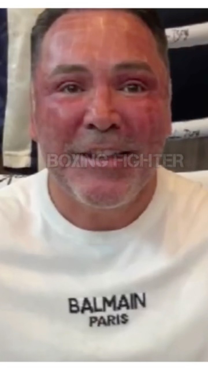 ÓSCAR DE LA HOYA REVELA POR QUÉ SU CARA LUCE DIFERENTE