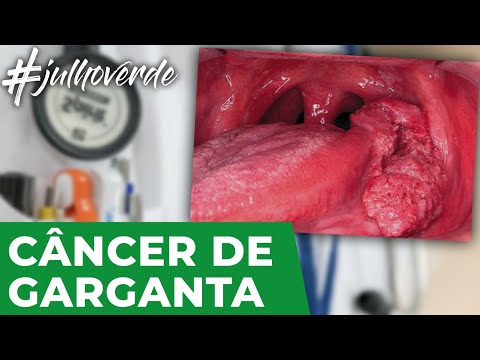 Vídeo: O câncer de orofaringe tem tratamento?