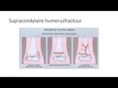 fractuurleer deel 2 de meest voorkomende fracturen