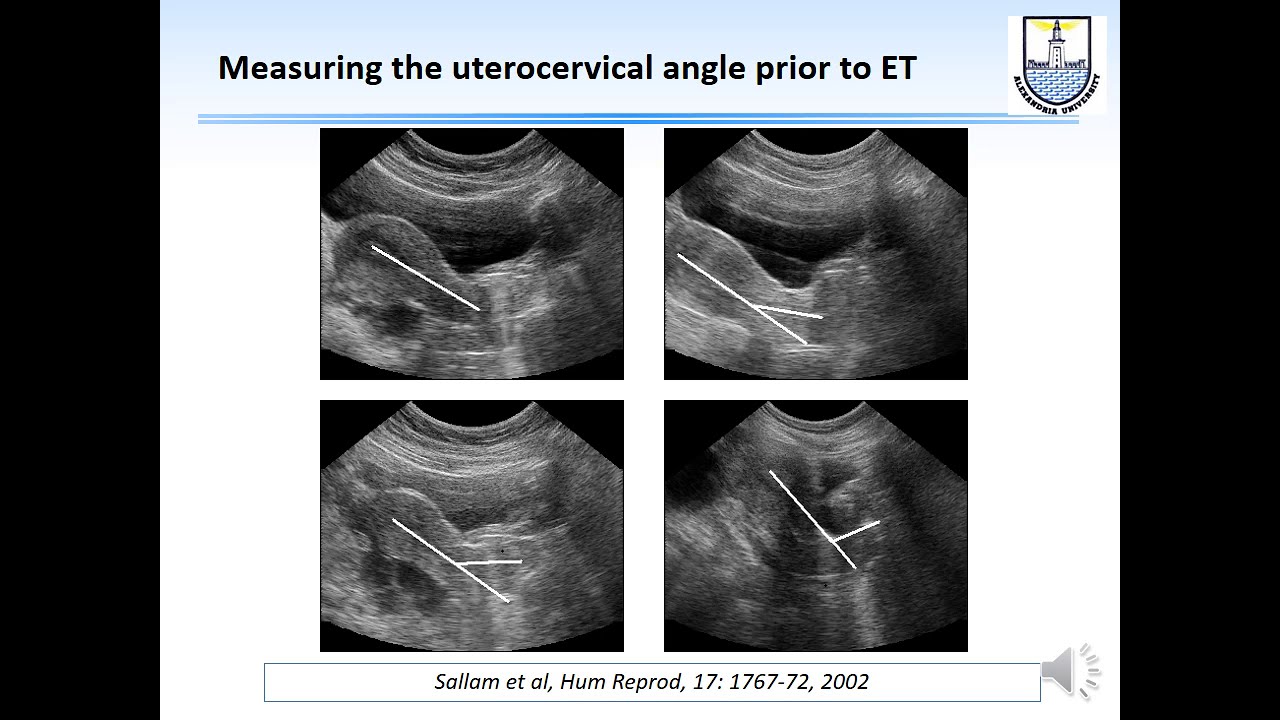 Optimizing embryo transfer - English