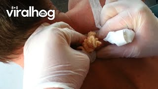 30 Year Old Cyst Explosion