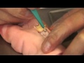 Understand Wound Care: Sharp Debridement Demo of Wound with Yellow Necrosis