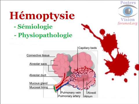 Vidéo: Syndrome D'hémoptysie - Causes, Diagnostic, Méthodes De Traitement