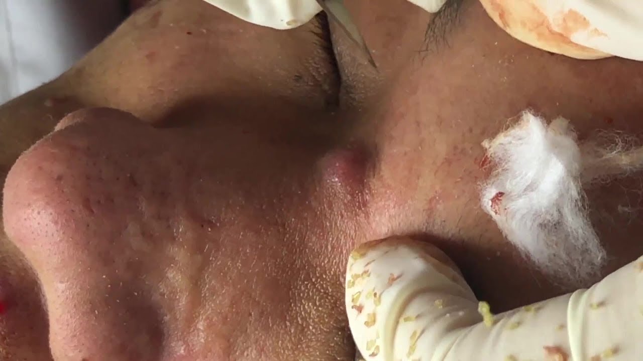 Viêm Da,  Mụn Mủ
