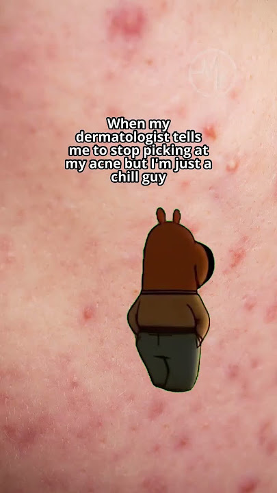 Even chill guys get acne 💔