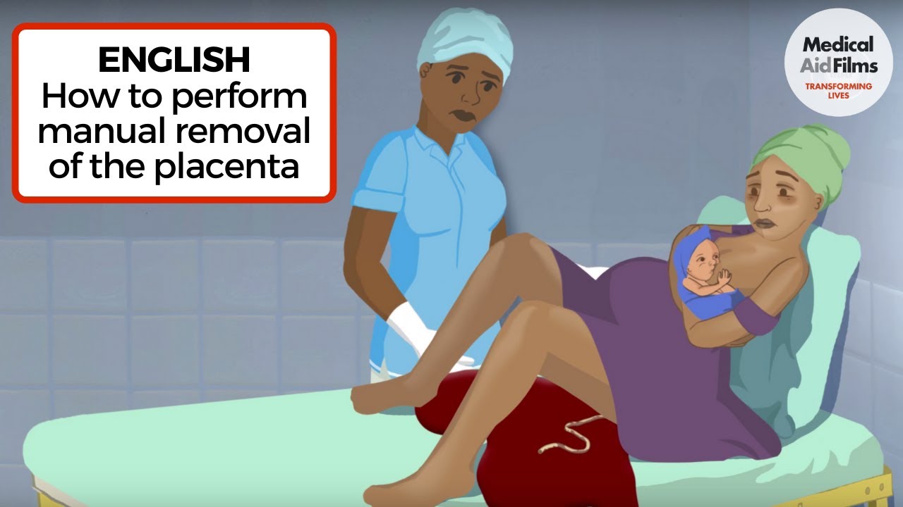 How Do You Manually Remove A Retained Placenta?