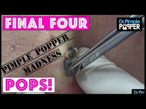 Our FOUR FINAL POPS For You - PIMPLE POPPER MADNESS!!