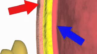 Paracentesis NEJM