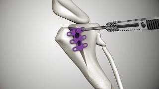 Tibial Tuberosity Advancement Tta Rapid