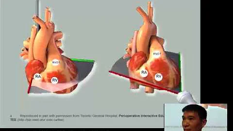 Echocardiographi...  assessment of the right ventr...