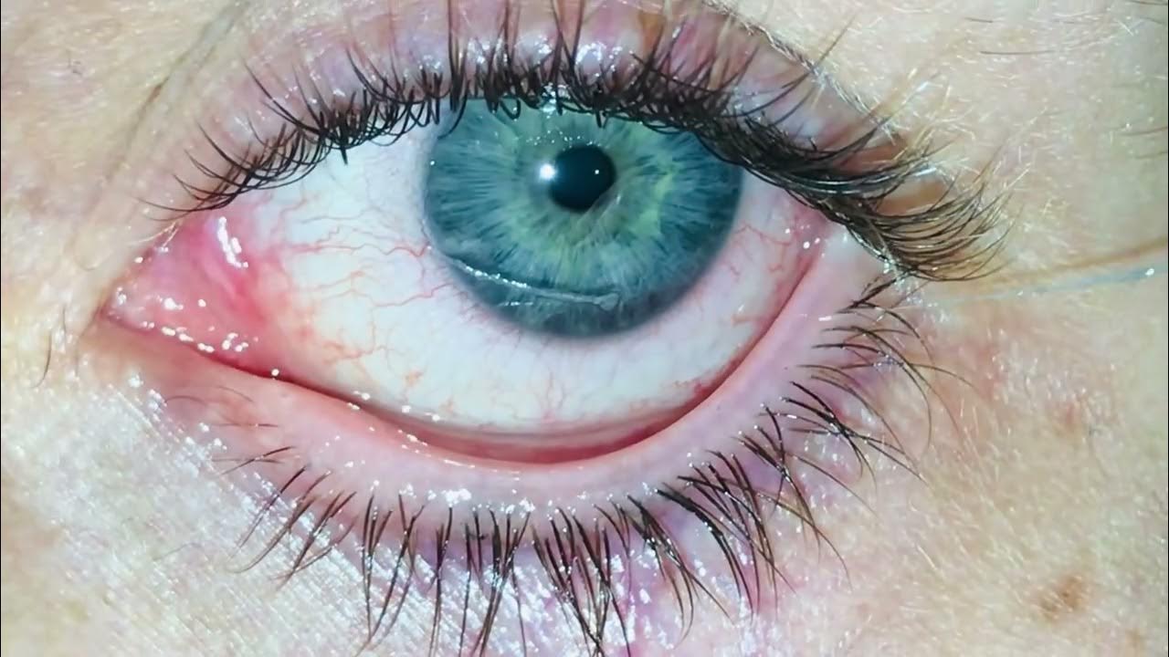 Eye mucous fishing syndrome YouTube