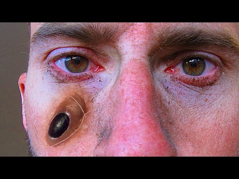 blackheads popping blackhead heads