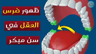 ظهور ضرس العقل في سن مبكر