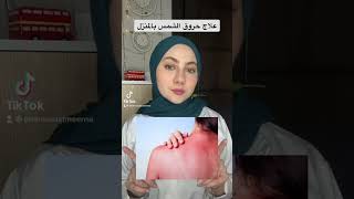 علاج حروق الشمس بالمنزل 🚫❌