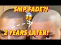 Smp 2 years later 4th session permanent fade scalp micropigmentation