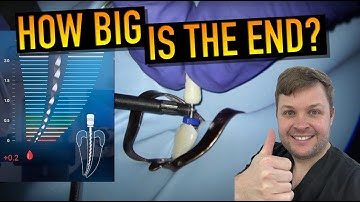 📌 Master Apical Gauging for Wide Canals!