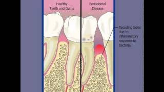 Healthy Tooth vs Tooth with Gum Disease from the American Academy of Periodontology