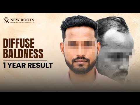 Diffuse Baldness… GONE?! 😳 | This Hairline Looks SO Natural | Hair Transplant in Mumbai | New Roots