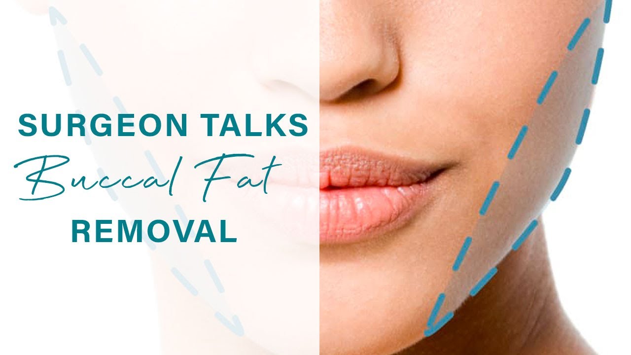 Buccal Fat Removal | A Facial Plastic Surgeon's Input