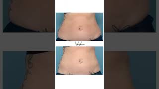 Before & After CoolSculpting