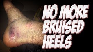 bruised my heel
