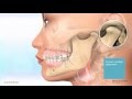 Carriere® Motion™ Appliance for Class II Patient Education Animation 2