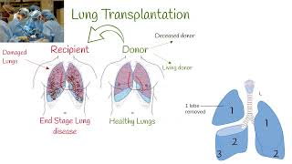 Lung Transplant Surgery, Survival, Organ Rejection. RiskBenefit