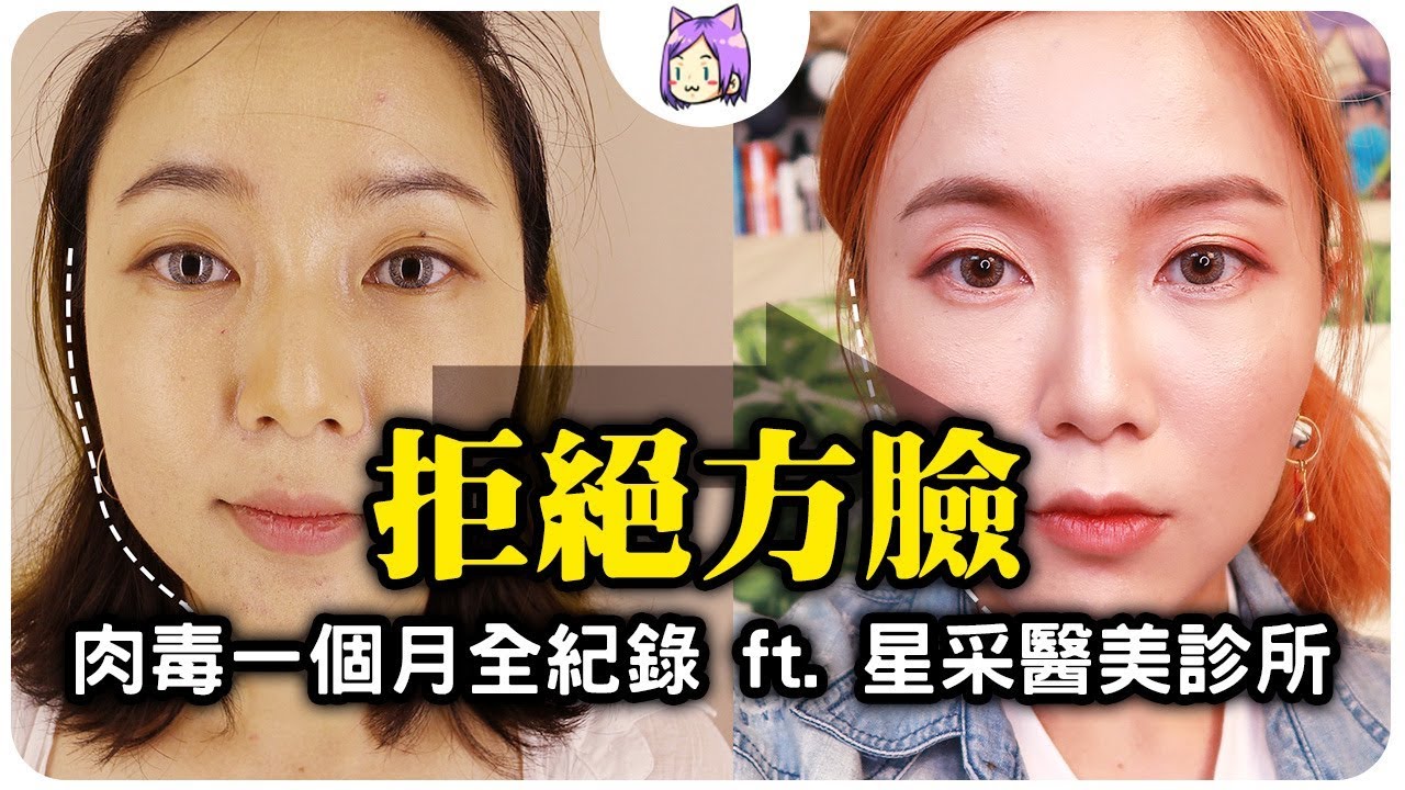 醫美 肉毒瘦臉一個月全紀錄 意外戀上彩衝光ft 星采醫美診所 Neko嗚喵 Youtube