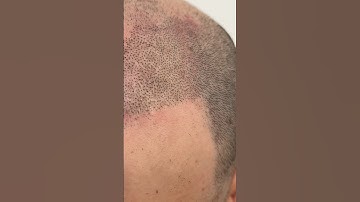 What happens at your First Session of #scalpmicropigmentation ??