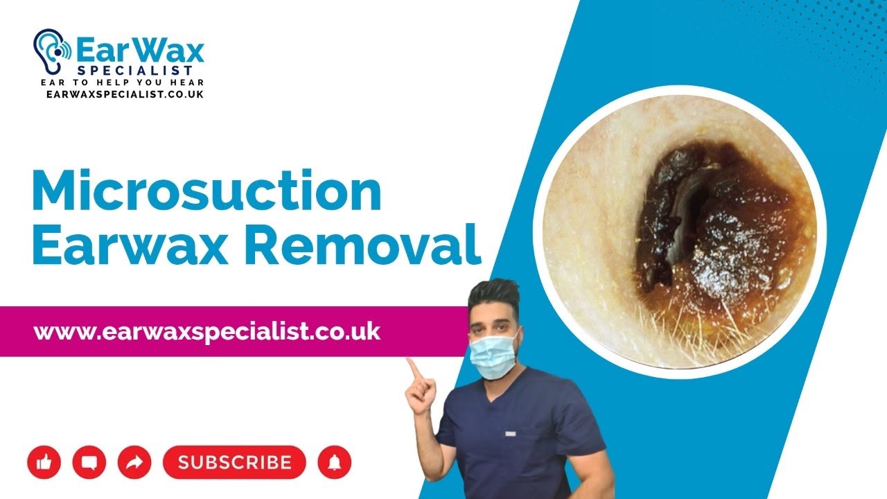 Ear Wax Removal Deep Impacted Painful!!!! YouTube