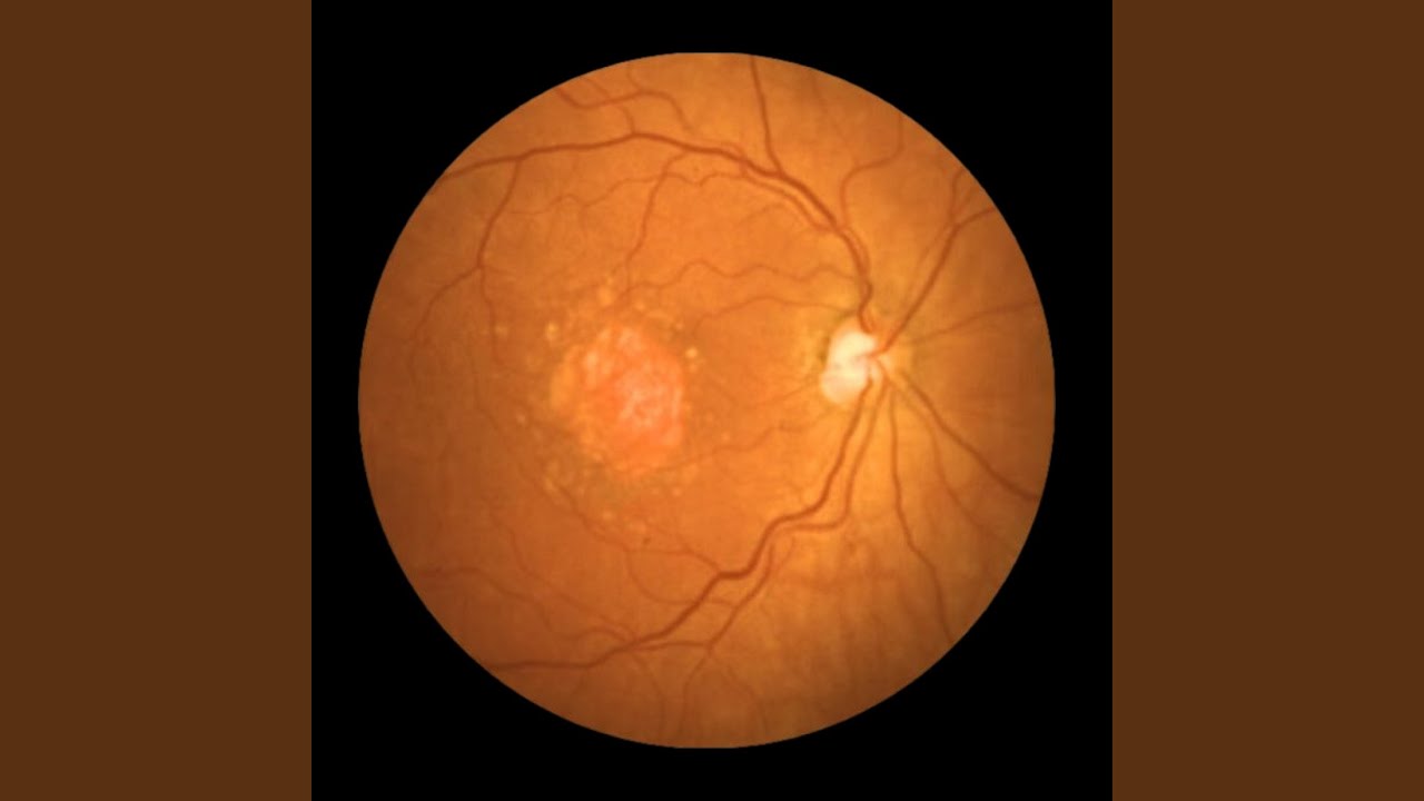 Avacincaptad Pegol (Geographic Version)