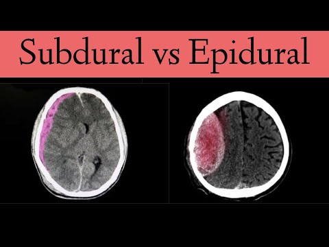 Subdural vs Epidural Hematoma/Hemorrhage [CT Scan Findings]