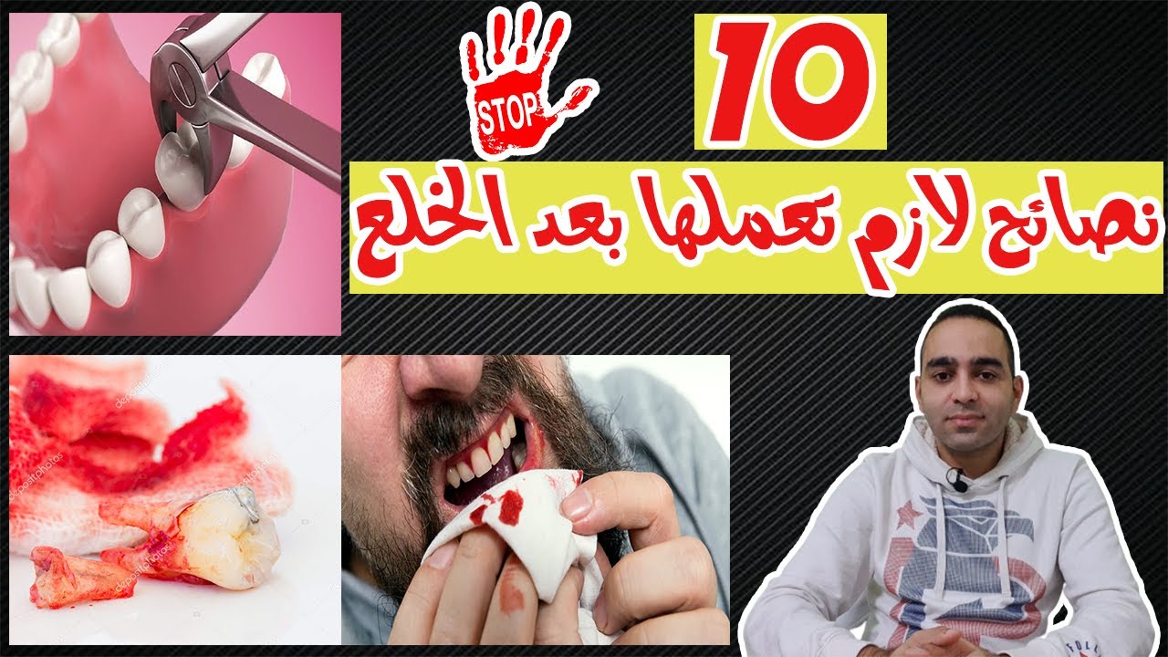 10 تعليمات ونصائح هامة بعد خلع الاسنان لتجنب نزيف والتهاب الجرح | طرق ايقاف النزيف والالم بعد الخلع