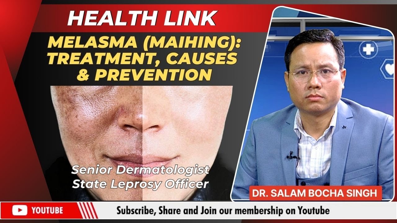 MELASMA (MAIHING): TREATMENT, CAUSES & PREVENTION     | 11 JAN  2025
