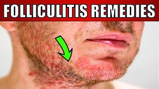 How to treat Folliculitis /fungal acne (head bumps) HOME REMEDIES & TREATMENT