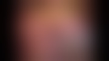 Robotic Ureteral Reimplantation into Ileal Conduit Urinary Diversion