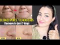 4 DAYS CHALLENGE : Remove Clogged Pores, Blackheads & Whiteheads in just 4 uses | Preity प्रेरणा