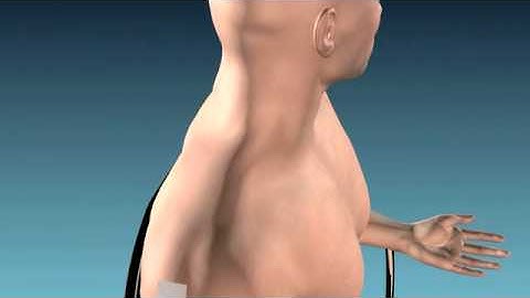 Myoguide: Needle EMG Guided Injection Technique