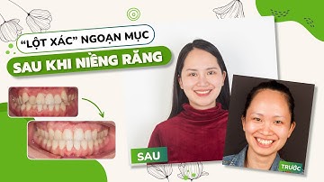 Niềng răng hô (vẩu) và kết quả sau khi tháo mắc cài