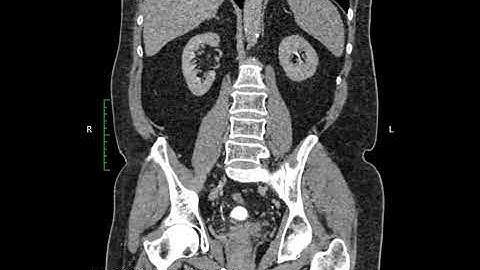 Ct Urogram Excretory coronal