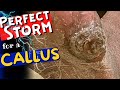 The perfect storm for a callus diabetes neuropathy dry skin and fat pad loss