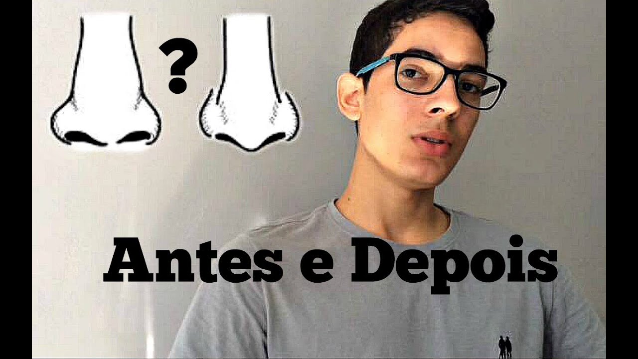 Diminuir o nariz sem cirurgia plástica. Funciona? Antes e Depois YouTube Diminuir o nariz sem cirurgia plástica. Funciona? Antes e Depois YouTube