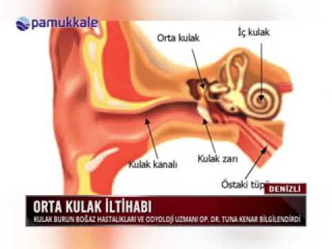 Orta Kulak İltihabı - Op. Dr. Tuna Kenar