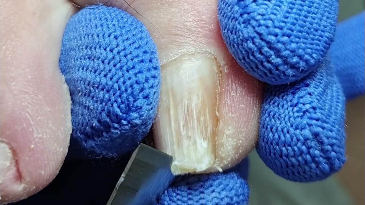 The toenails are too deep in the flesh YouTube