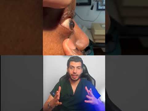 القرنية المخروطية قرنية مخروطية القرنية المخروطية العين طب العيون د مصعب حسوا ثقف نفسك طبيا
